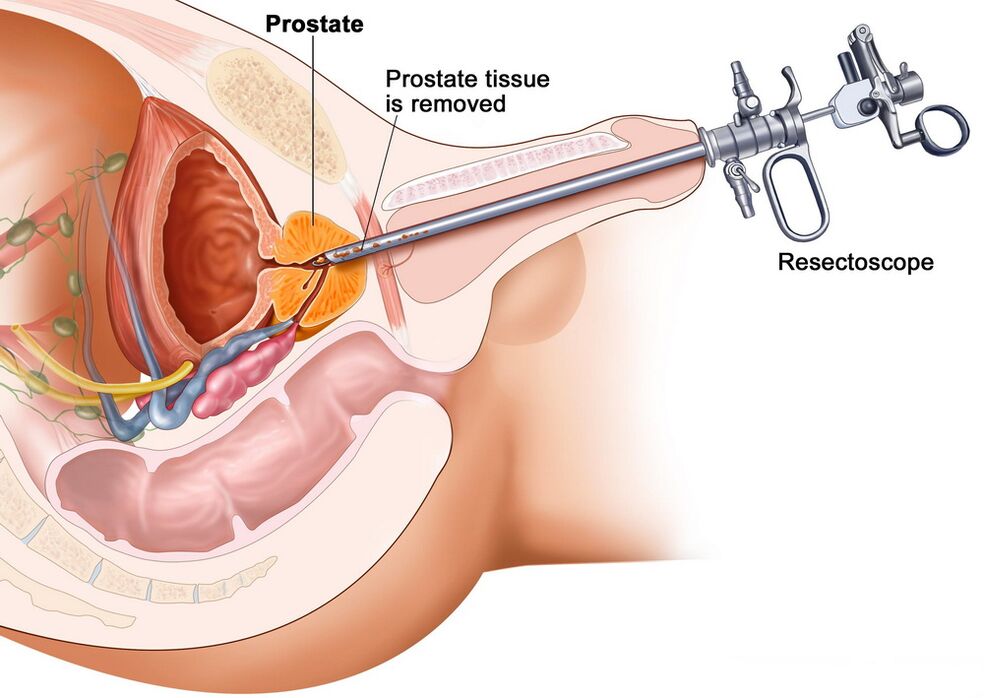 Odvzem tkiva prostate za natančno diagnozo prostatitisa