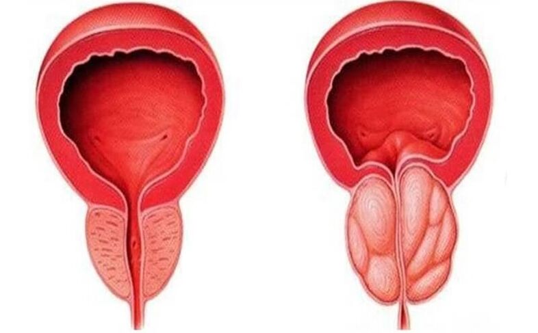zdrava in vneta prostata s prostatitisom