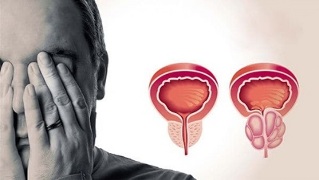 vzroki za prostatitis pri moških