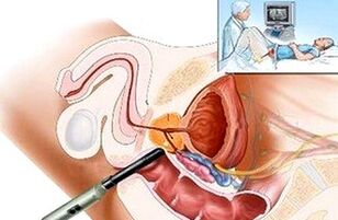 načine za diagnosticiranje prostatitisa