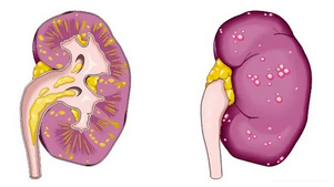kaj povzroča akutni prostatitis