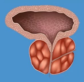 Tipični simptomi prostatitis