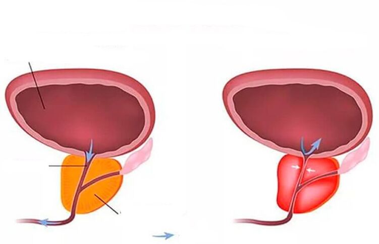 normalna in vneta prostata