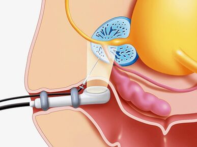 Punkcijska biopsija prostate