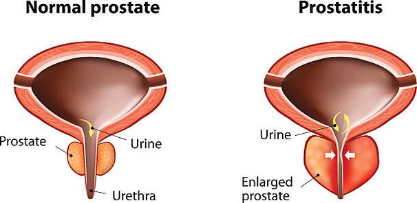 normalna in vneta prostata