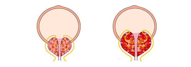 zdrava in vneta prostata s prostatitisom